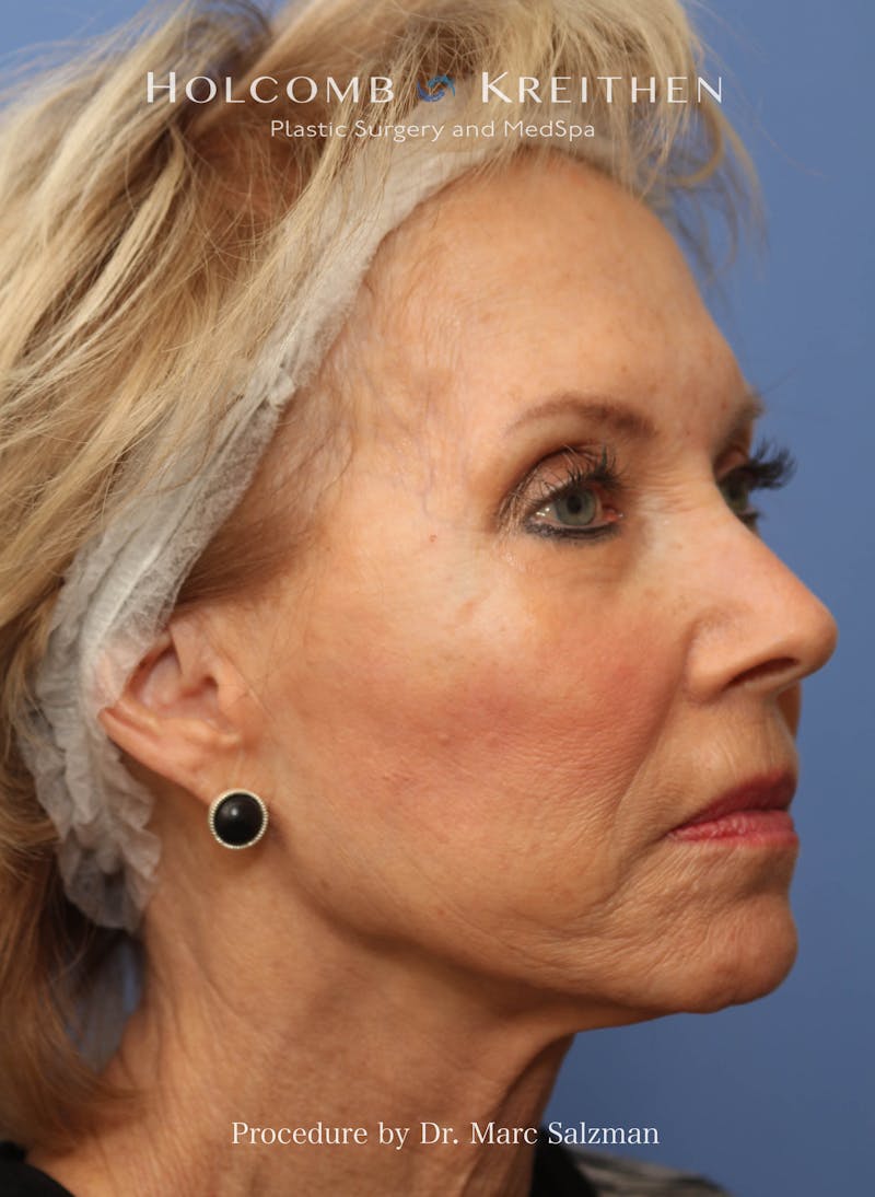 eCO2 Fractional Laser Before & After Gallery - Patient 286276 - Image 5