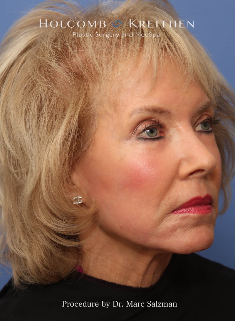 eCO2 Fractional Laser Before & After Gallery - Patient 286276 - Image 6