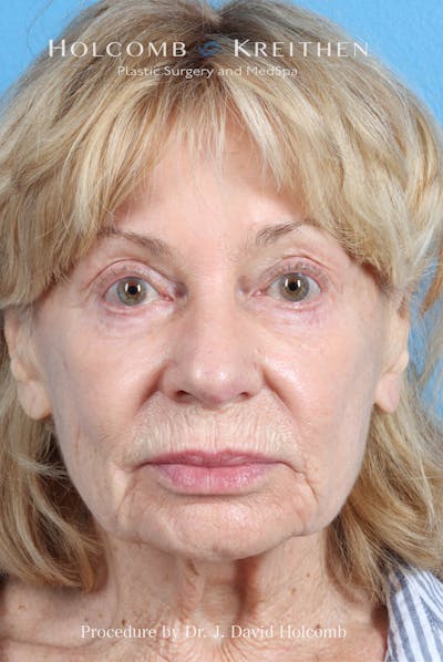 eCO2 Fractional Laser Before & After Gallery - Patient 195215 - Image 1