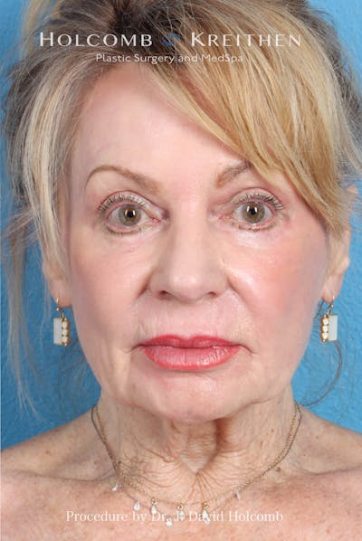 eCO2 Fractional Laser Before & After Gallery - Patient 195215 - Image 2