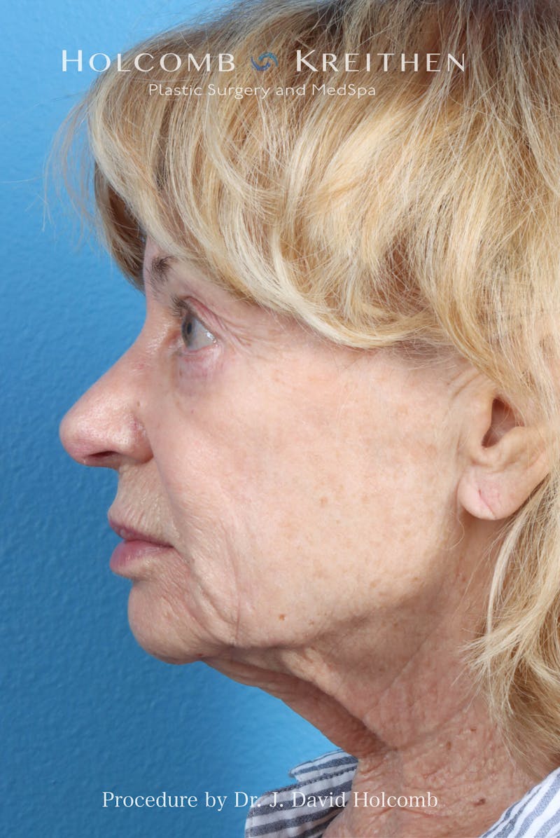 eCO2 Fractional Laser Before & After Gallery - Patient 195215 - Image 3