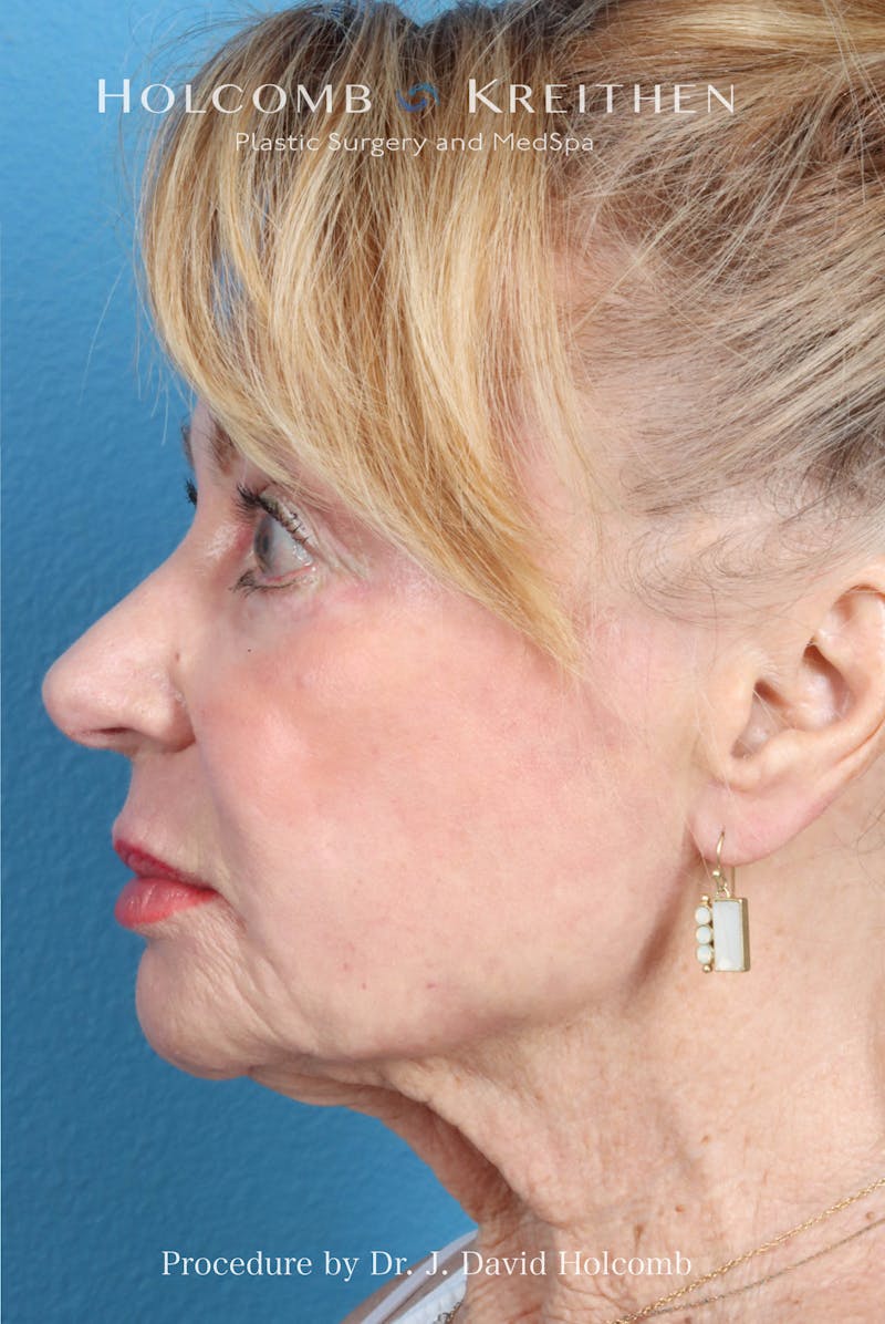 eCO2 Fractional Laser Before & After Gallery - Patient 195215 - Image 4