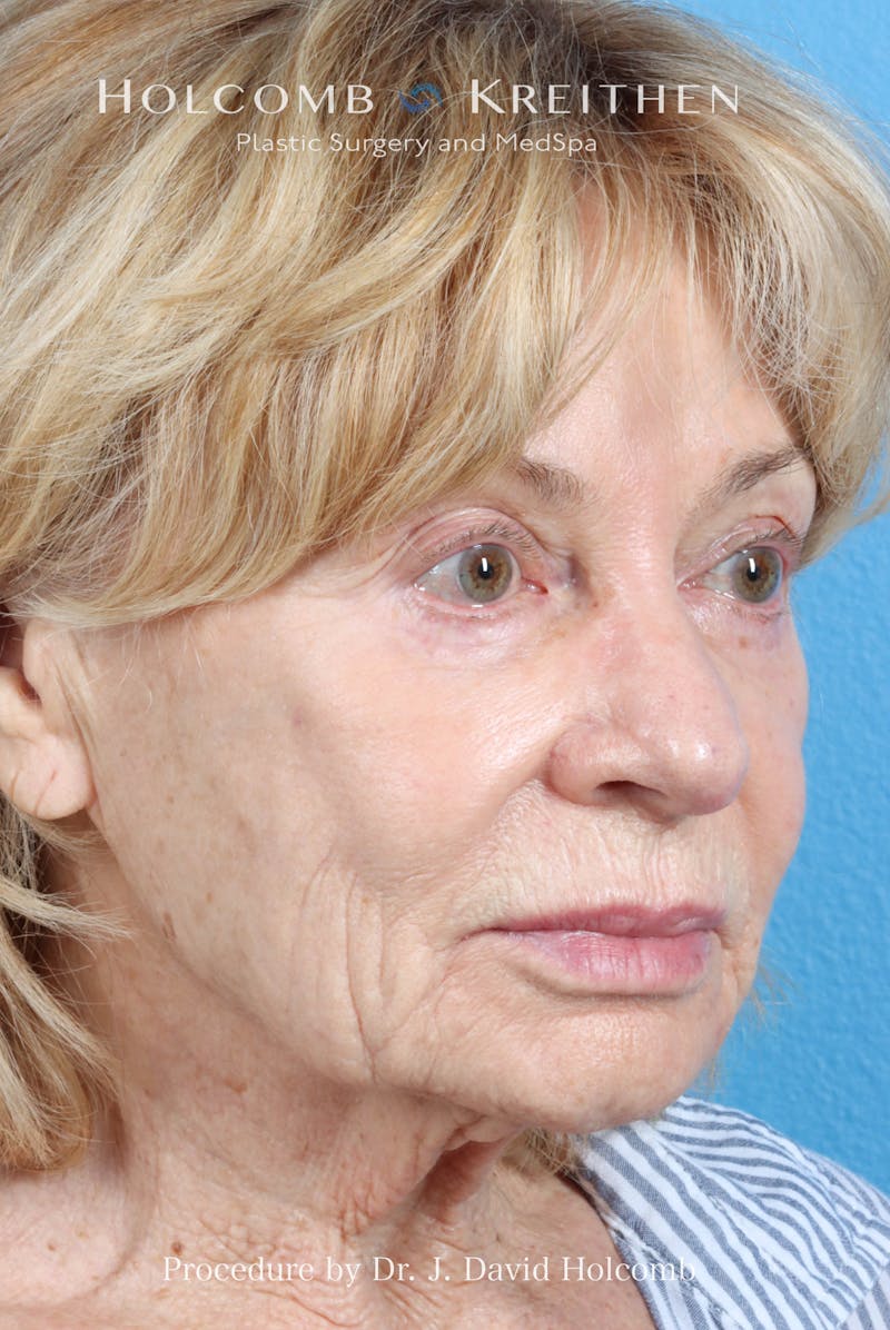 eCO2 Fractional Laser Before & After Gallery - Patient 195215 - Image 5