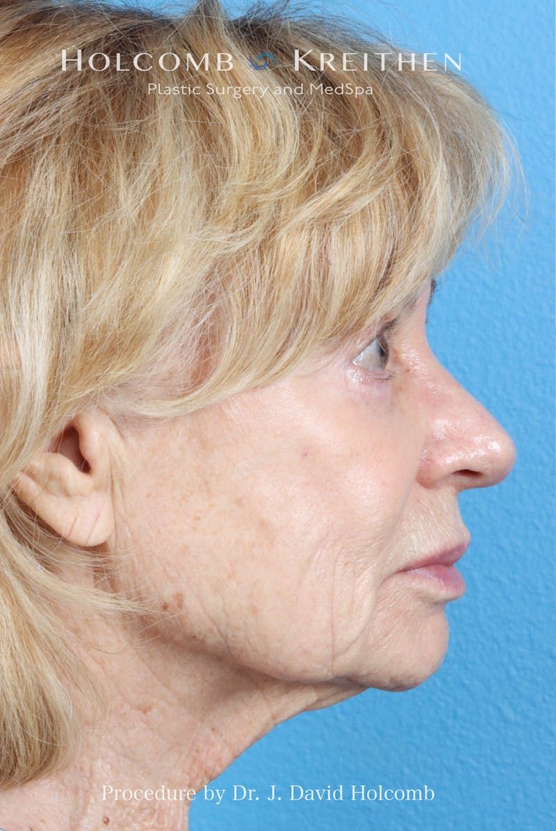 eCO2 Fractional Laser Before & After Gallery - Patient 195215 - Image 7
