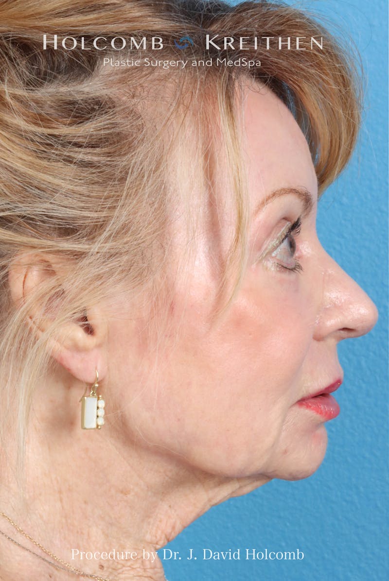 eCO2 Fractional Laser Before & After Gallery - Patient 195215 - Image 8
