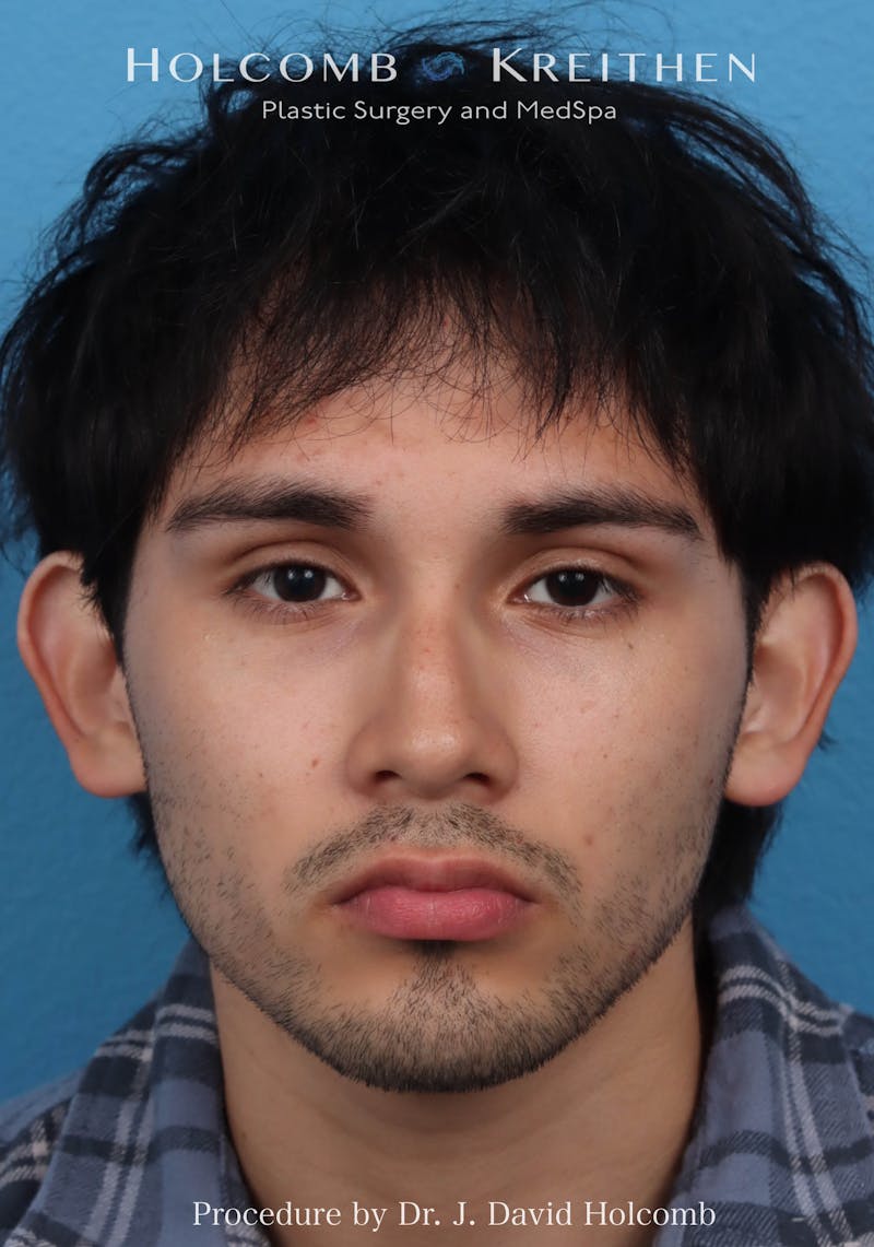Otoplasty Before & After Gallery - Patient 113083 - Image 1