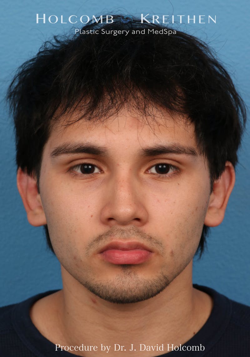 Otoplasty Before & After Gallery - Patient 113083 - Image 2