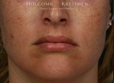BBL Laser Before & After Gallery - Patient 919061 - Image 1