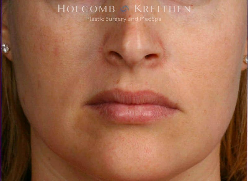 BBL Laser Before & After Gallery - Patient 919061 - Image 2