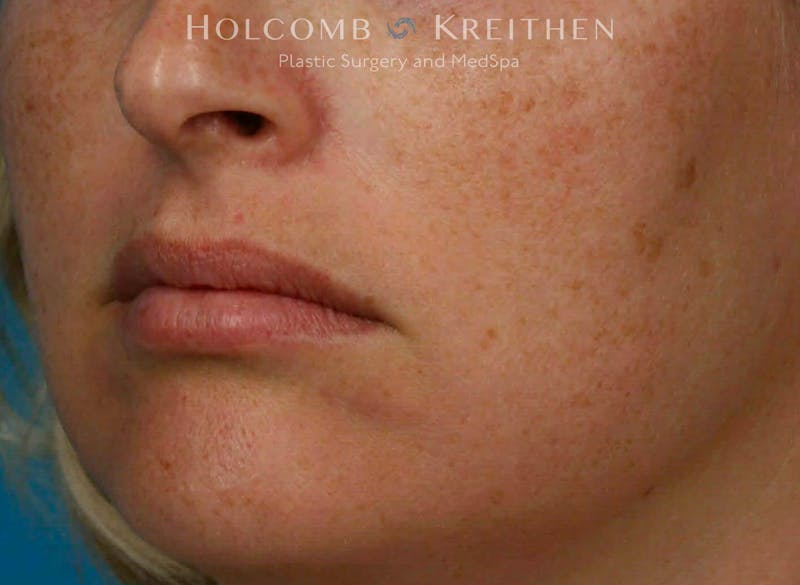 BBL Laser Before & After Gallery - Patient 919061 - Image 3