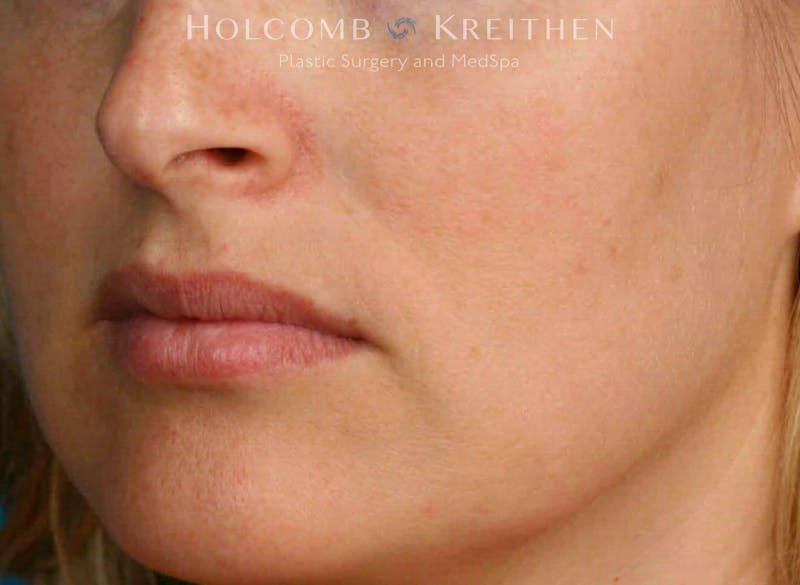 BBL Laser Before & After Gallery - Patient 919061 - Image 4