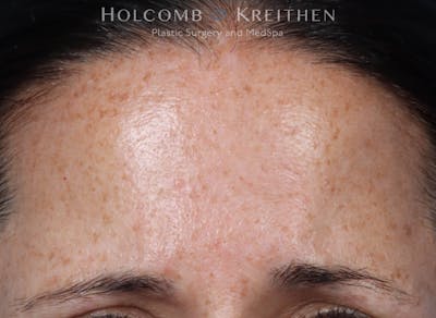 BBL Laser Before & After Gallery - Patient 344421 - Image 1