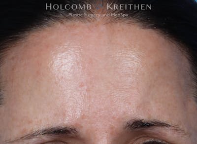 BBL Laser Before & After Gallery - Patient 344421 - Image 2