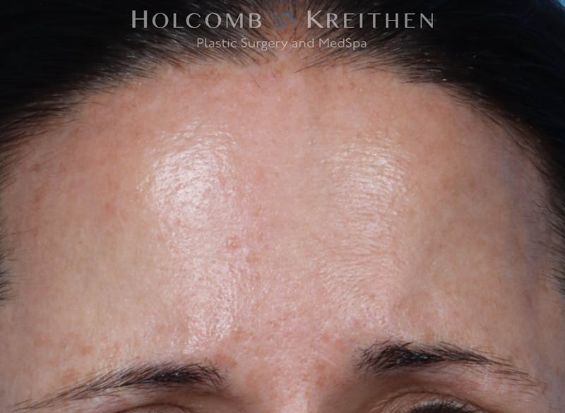 BBL Laser Before & After Gallery - Patient 344421 - Image 2