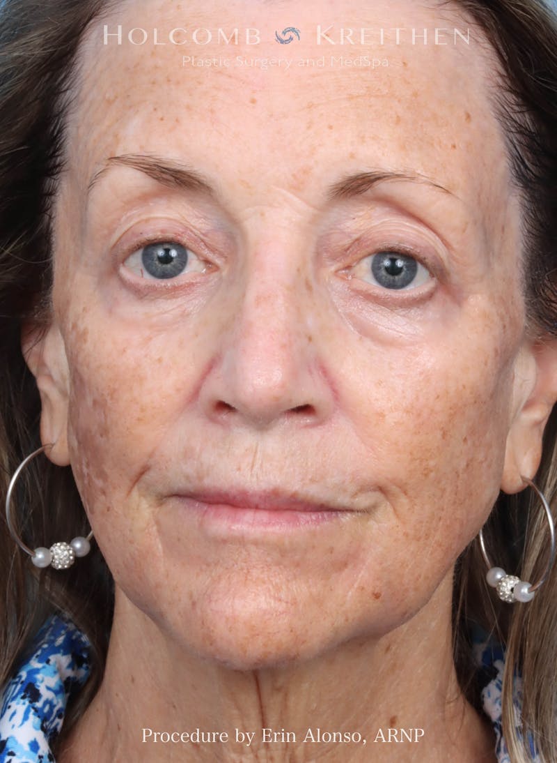 BBL Laser Before & After Gallery - Patient 219152 - Image 1