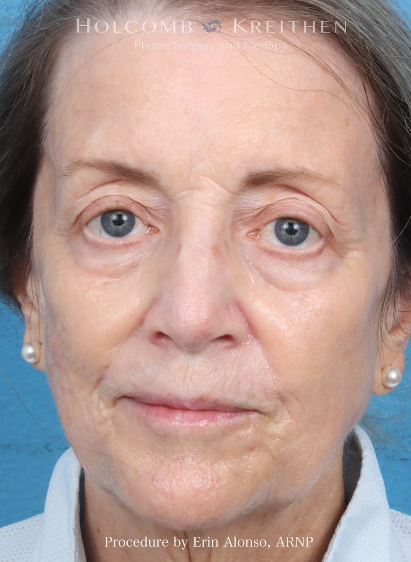 BBL Laser Before & After Gallery - Patient 219152 - Image 2