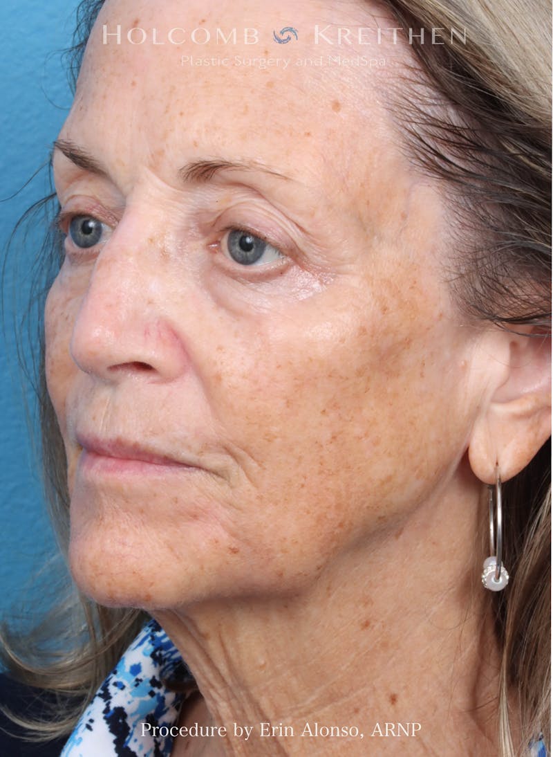 BBL Laser Before & After Gallery - Patient 219152 - Image 3