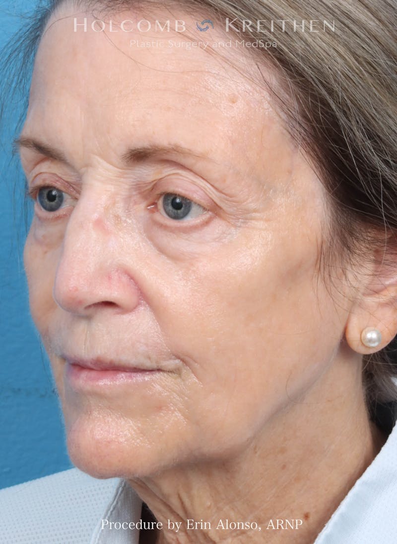 BBL Laser Before & After Gallery - Patient 219152 - Image 4