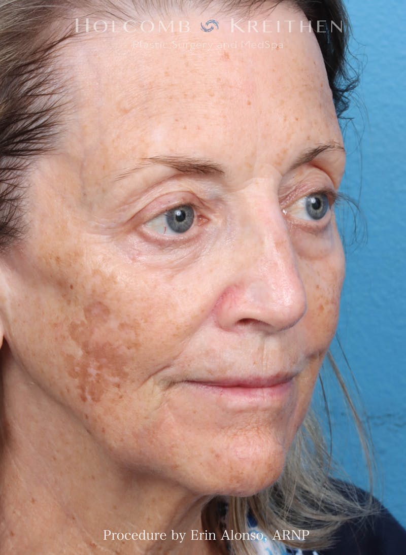 BBL Laser Before & After Gallery - Patient 219152 - Image 5