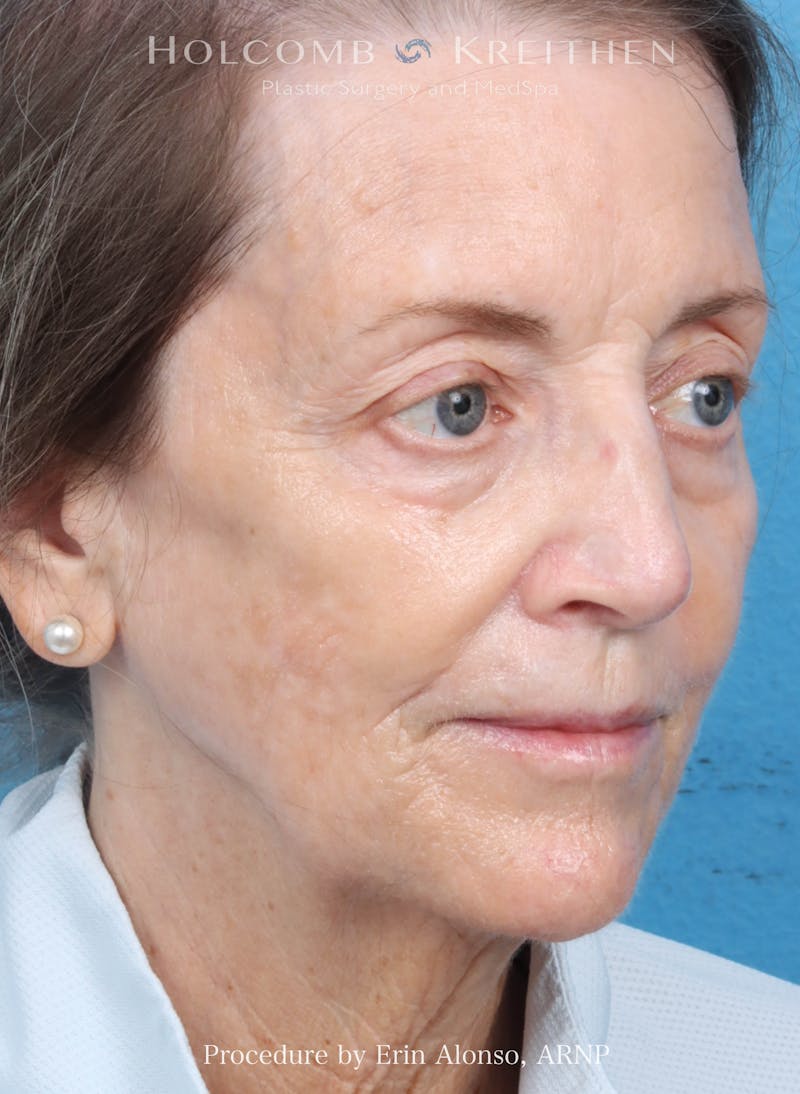 BBL Laser Before & After Gallery - Patient 219152 - Image 6
