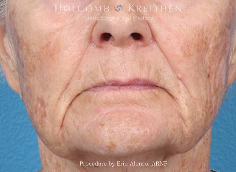 BBL Laser Before & After Gallery - Patient 264709 - Image 1