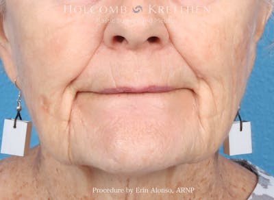 BBL Laser Before & After Gallery - Patient 264709 - Image 2