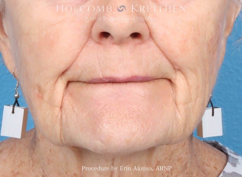 BBL Laser Before & After Gallery - Patient 264709 - Image 2