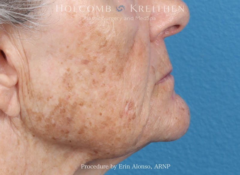 BBL Laser Before & After Gallery - Patient 264709 - Image 3