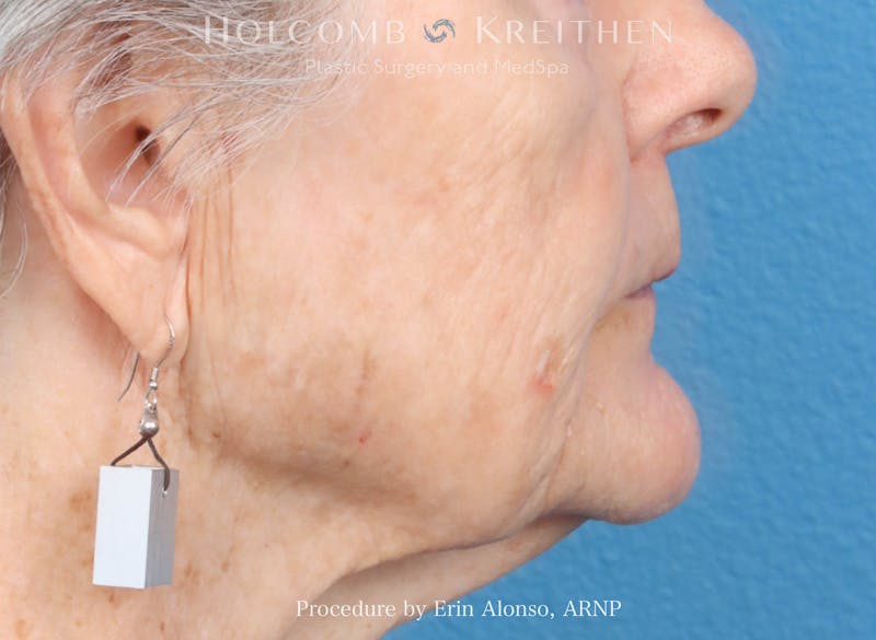 BBL Laser Before & After Gallery - Patient 264709 - Image 4