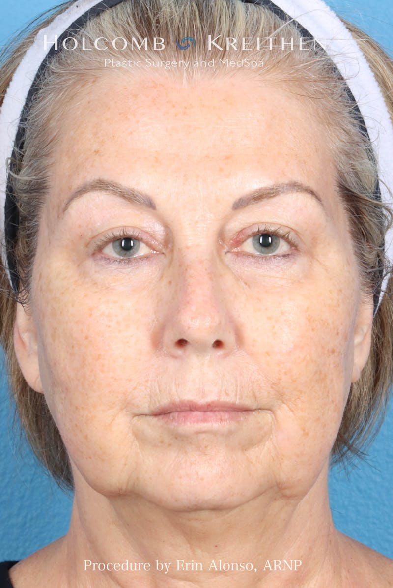 BBL Laser Before & After Gallery - Patient 291374 - Image 1