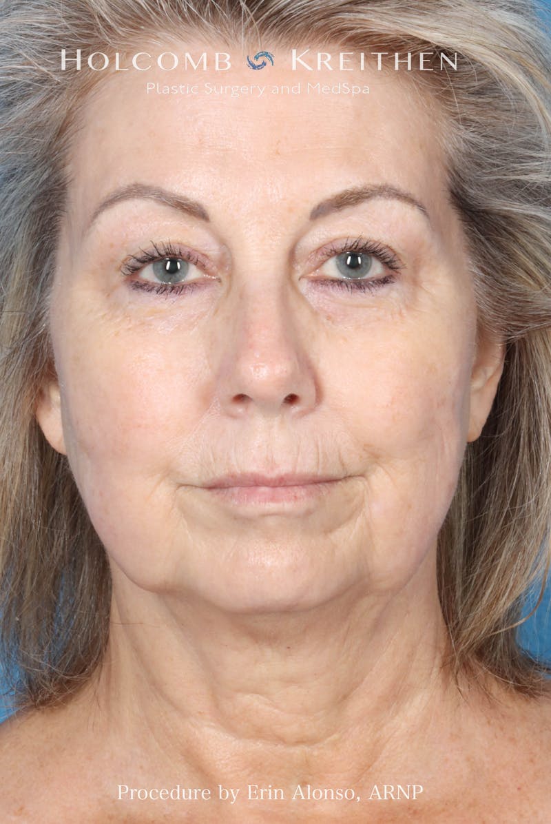 BBL Laser Before & After Gallery - Patient 291374 - Image 2
