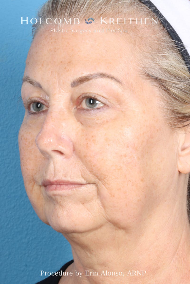 BBL Laser Before & After Gallery - Patient 291374 - Image 3