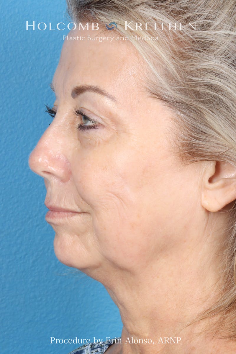 BBL Laser Before & After Gallery - Patient 291374 - Image 4