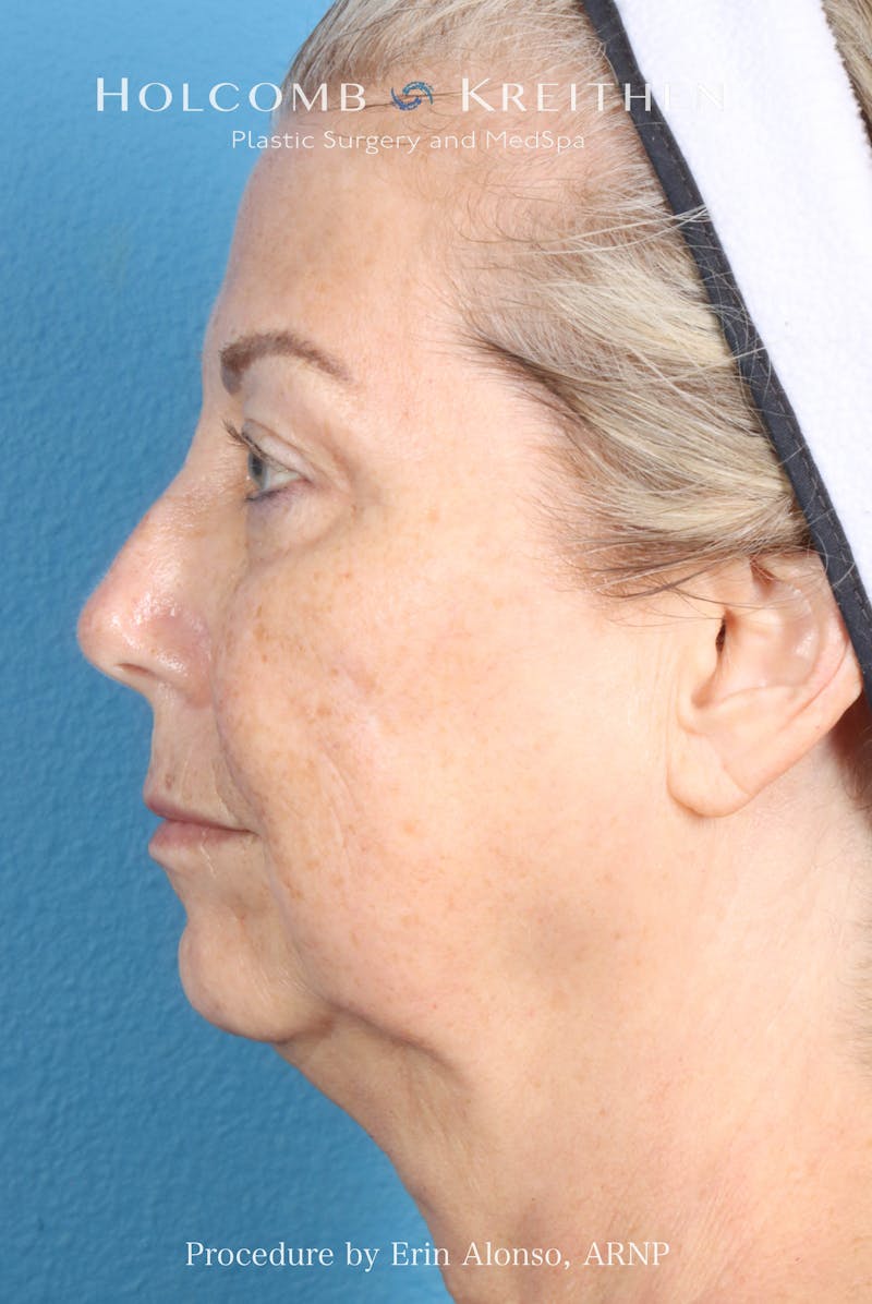 BBL Laser Before & After Gallery - Patient 291374 - Image 5