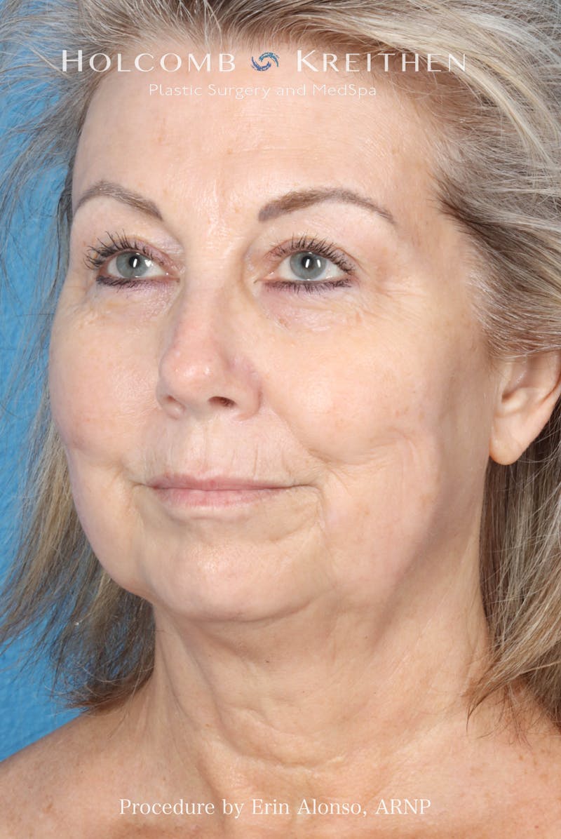 BBL Laser Before & After Gallery - Patient 291374 - Image 6