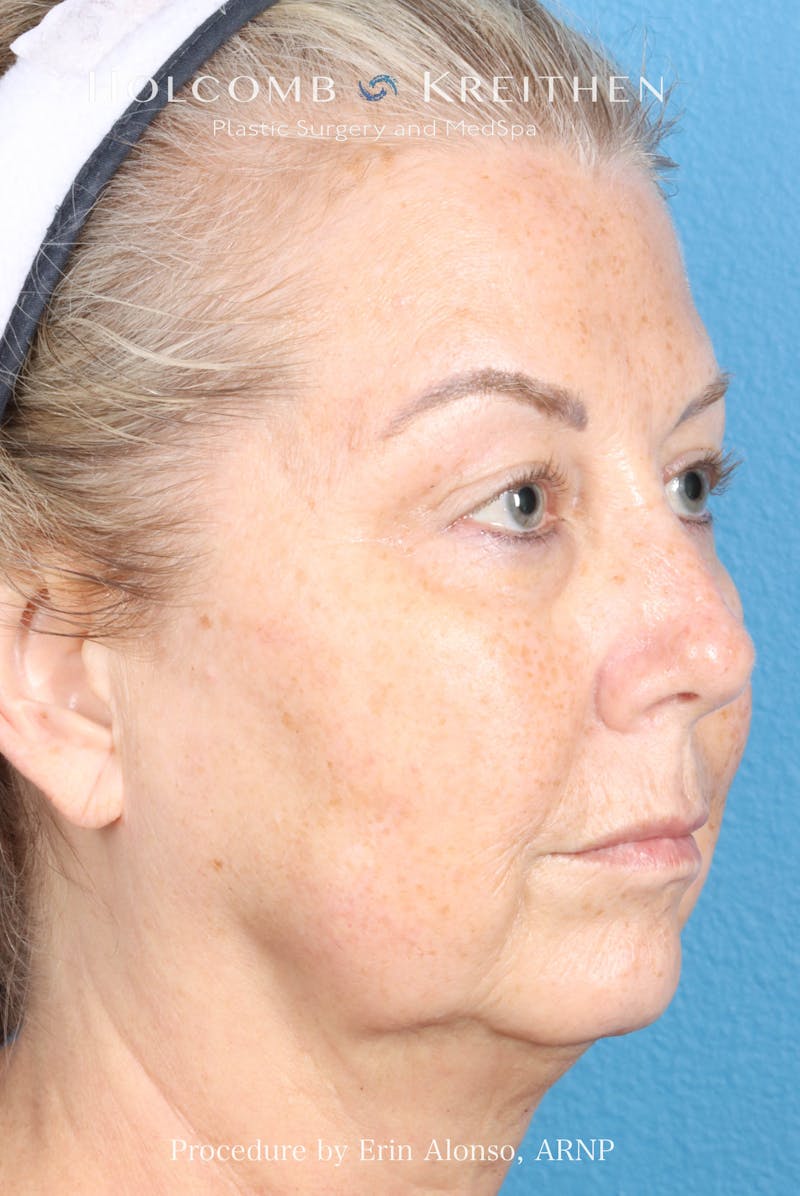 BBL Laser Before & After Gallery - Patient 291374 - Image 7