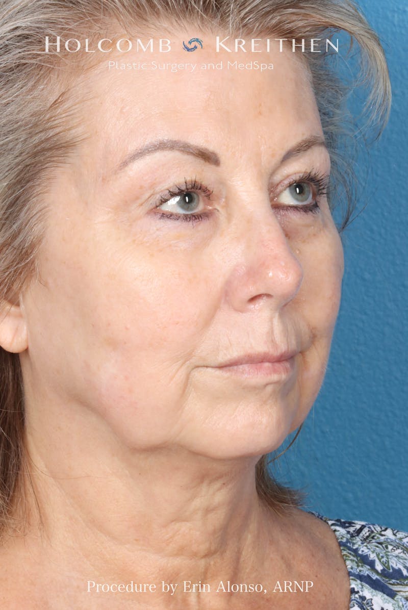BBL Laser Before & After Gallery - Patient 291374 - Image 8