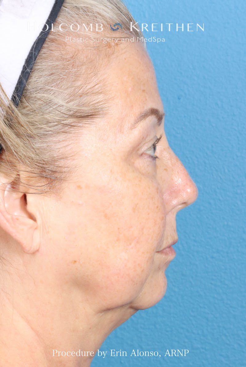 BBL Laser Before & After Gallery - Patient 291374 - Image 9