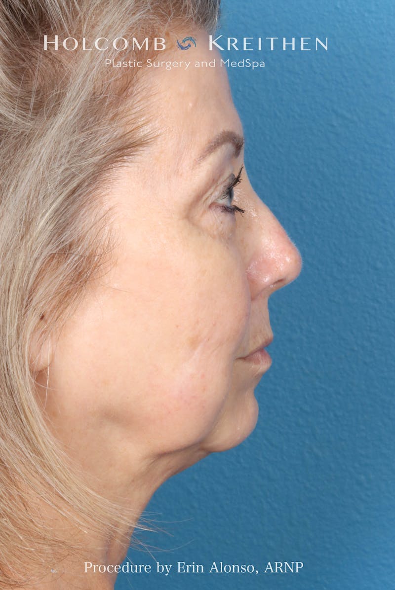 BBL Laser Before & After Gallery - Patient 291374 - Image 10