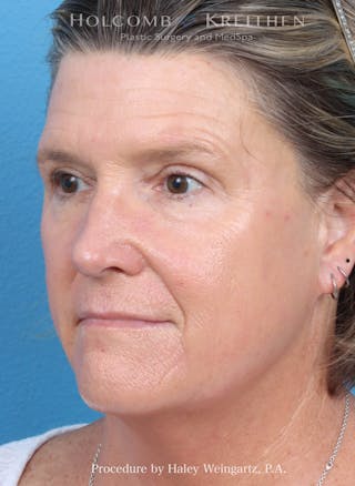 HALO Laser Before & After Gallery - Patient 216284 - Image 2