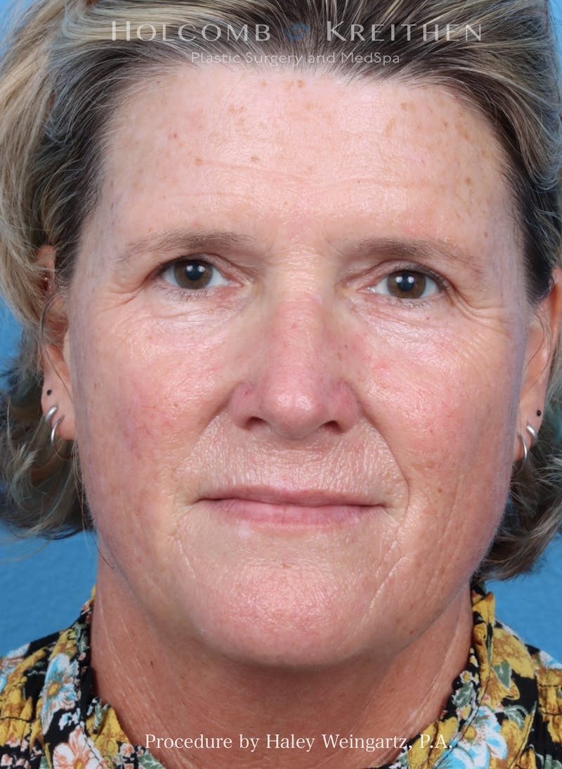 BBL Laser Before & After Gallery - Patient 331974 - Image 3