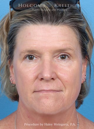 HALO Laser Before & After Gallery - Patient 216284 - Image 4