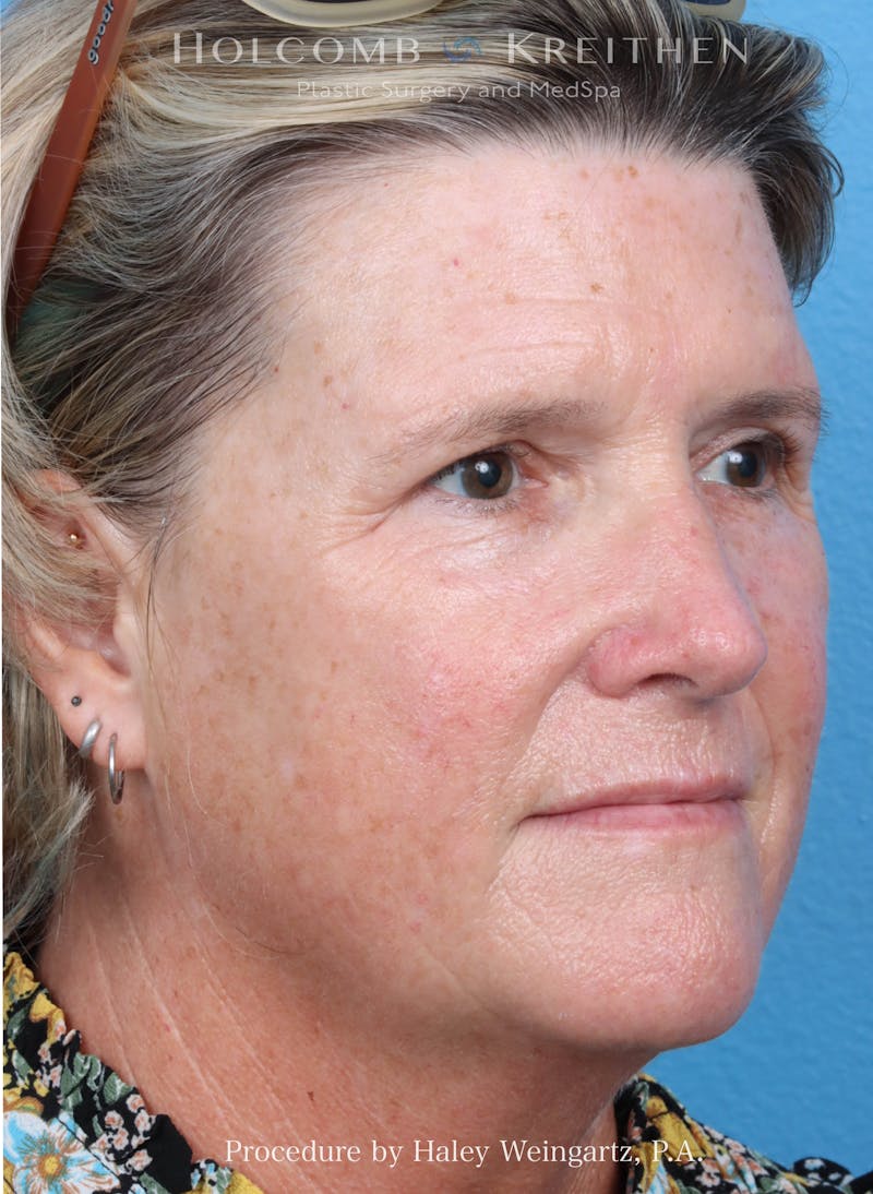 BBL Laser Before & After Gallery - Patient 331974 - Image 5