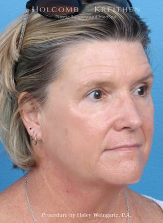 HALO Laser Before & After Gallery - Patient 216284 - Image 6