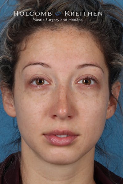 BBL Laser Before & After Gallery - Patient 244237 - Image 1