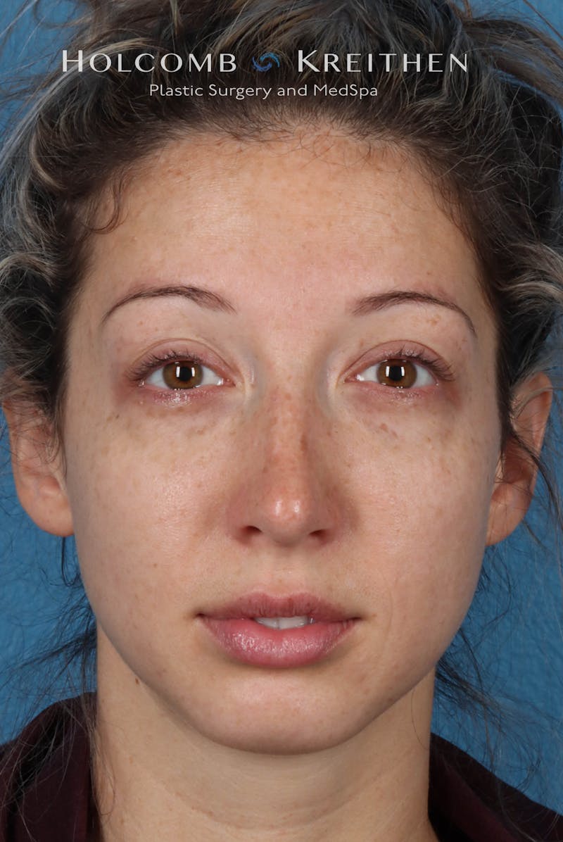 BBL Laser Before & After Gallery - Patient 244237 - Image 1