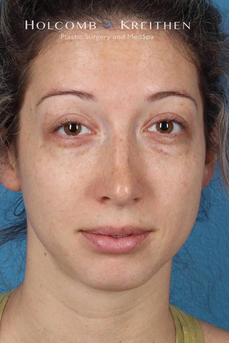 BBL Laser Before & After Gallery - Patient 244237 - Image 2