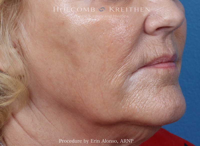 BBL Laser Before & After Gallery - Patient 228757 - Image 1