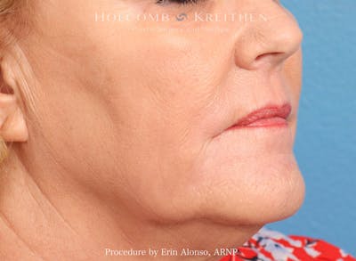 HALO Before & After Gallery - Patient 982094 - Image 2