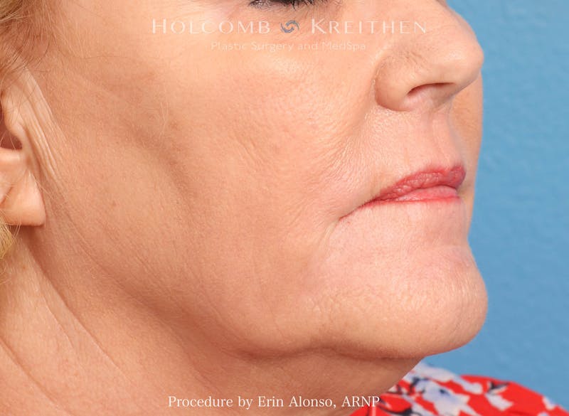 BBL Laser Before & After Gallery - Patient 228757 - Image 2